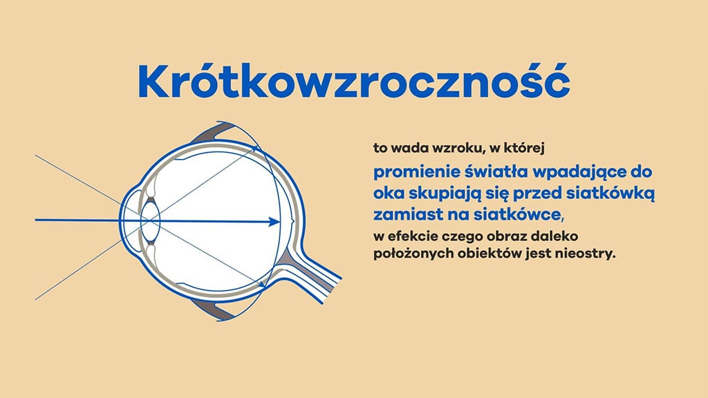 Czym jest krótkowzroczność? Czym jest krótkowzroczność?