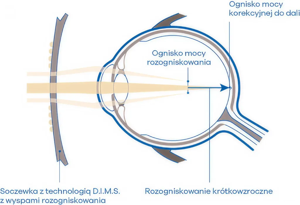 Schemat działania soczewki z technologią D.I.M.S.: ognisko mocy korekcyjnej do dali na siatkówce i ognisko rozogniskowania przed nią